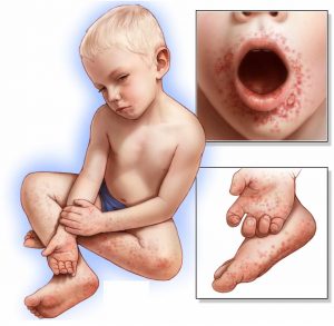 Çocuklarda El - Ayak- Ağız Hastalığı